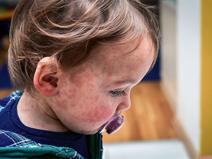 Measles Could Return to Endemic Status in U.S. If Vaccination Rates Remain Low